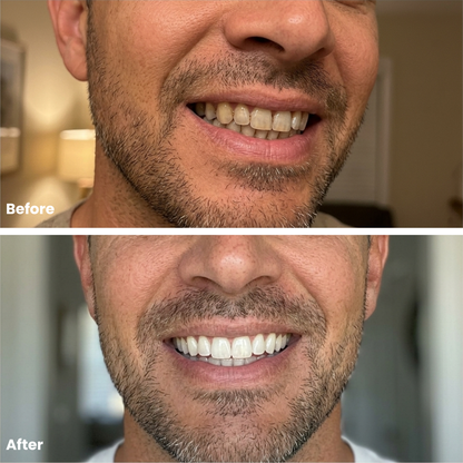Purple Teeth Whitening Mouthwash – Instant Colour Correcting Formula